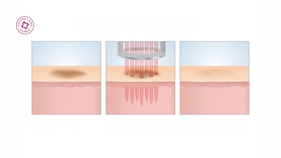 cơ chế khử thâm môi bằng laser co2 fractional