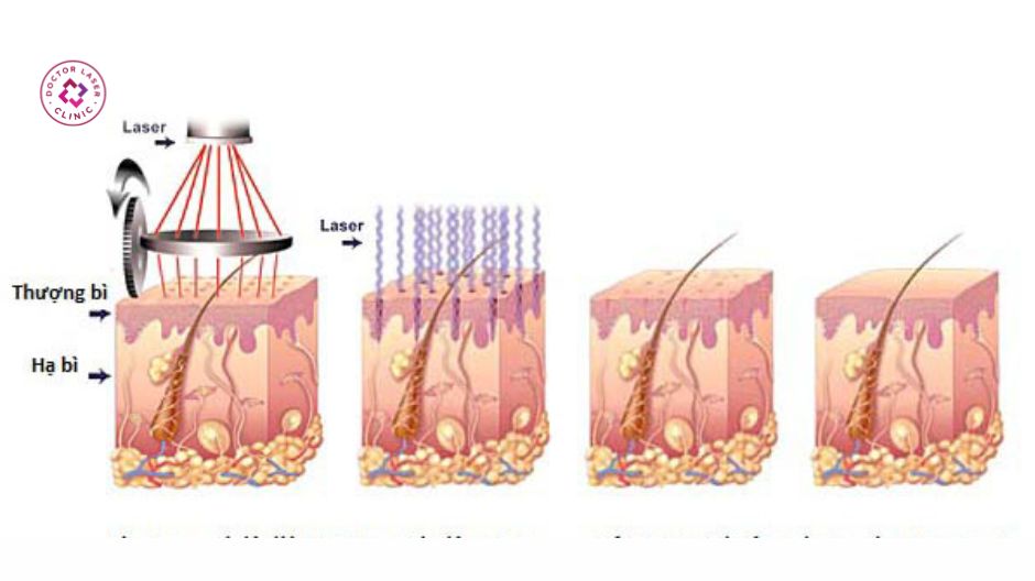 cơ chế trị mụn bằng laser co2 fractional