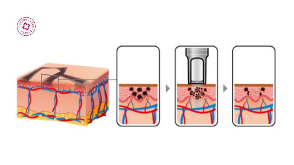 cơ chế xóa xăm picosecond laser