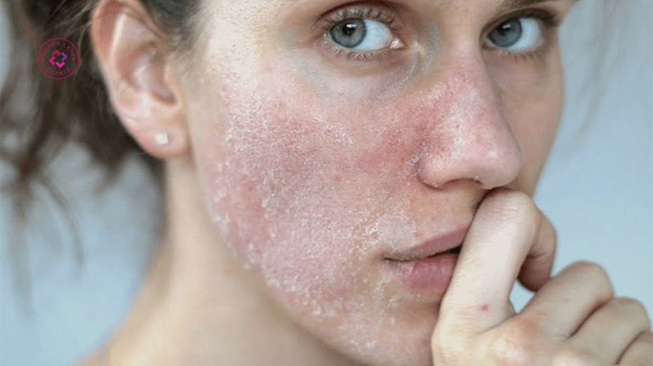 da đóng vảy bong tróc sau laser co2 fractional