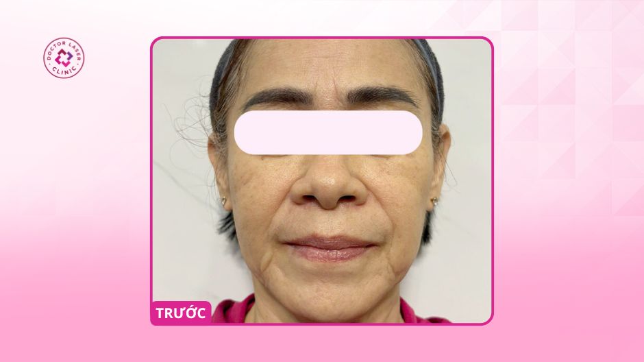 da mặt chảy xệ trước khi căng chỉ collagen