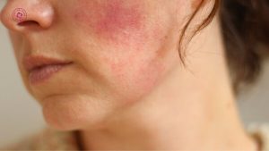 da mỏng có dễ bầm tím hơn khi căng chỉ không da mỏng có dễ bầm tím hơn khi căng chỉ không