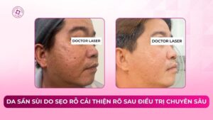 da sần sùi do sẹo rỗ cải thiện rõ sau điều trị