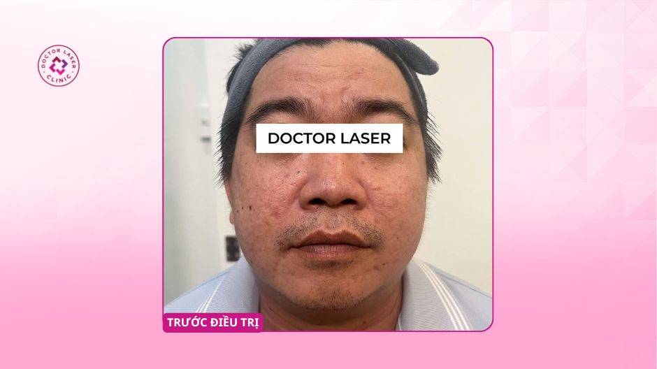 da sần sùi sẹo rỗ trước khi điều trị