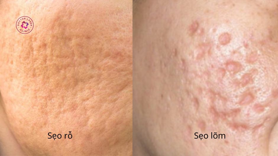 đặc điểm chung sẹo rỗ và sẹo lõm