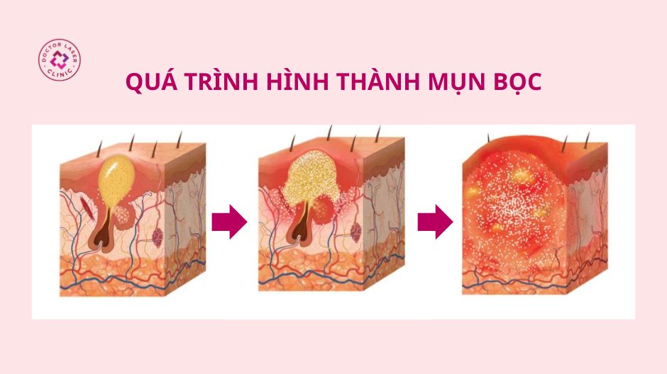 dấu hiệu mụn bọc ở lưng