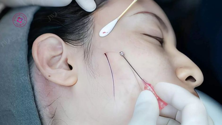 đau nhẹ tại vị trí luồn chỉ