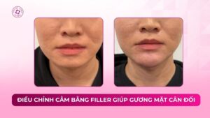 điều chỉnh cằm bằng filler giúp gương mặt cân đối điều chỉnh cằm bằng filler giúp gương mặt cân đối