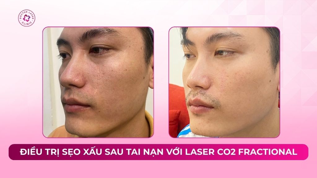 Điều trị sẹo xấu sau tai nạn với Laser CO2 Fractional