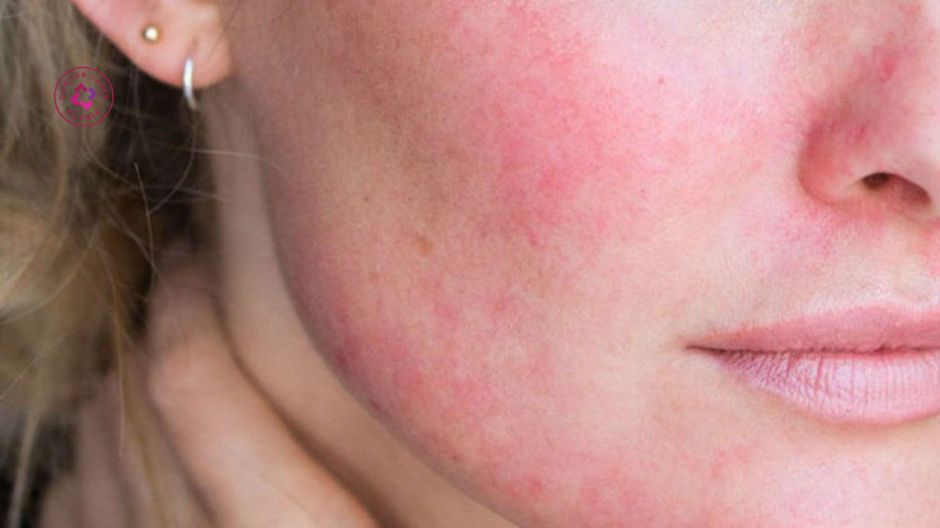 đỏ da sau tiêm meso