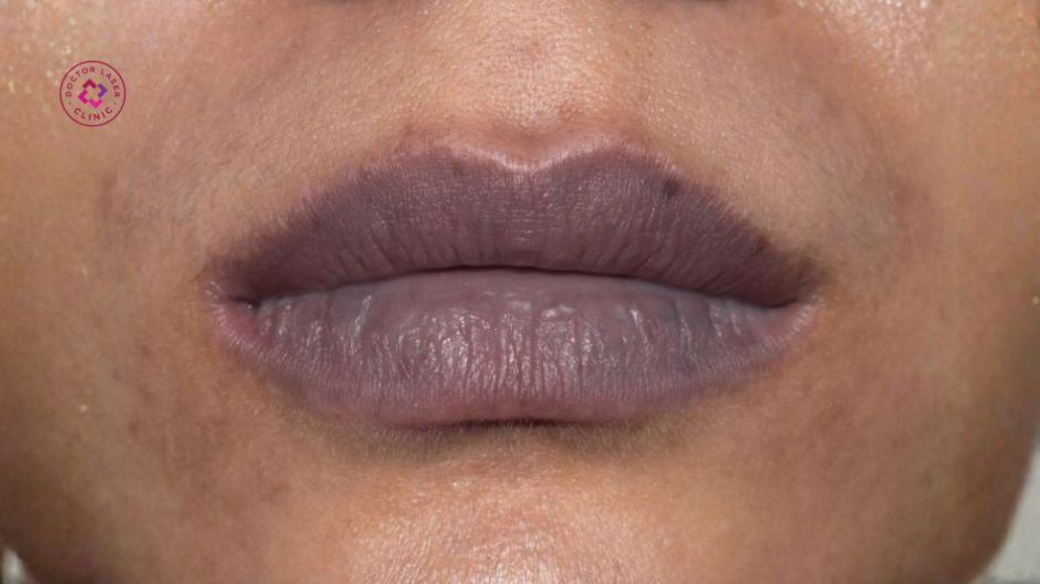 đối tượng phù hợp khử thâm môi bằng laser co2