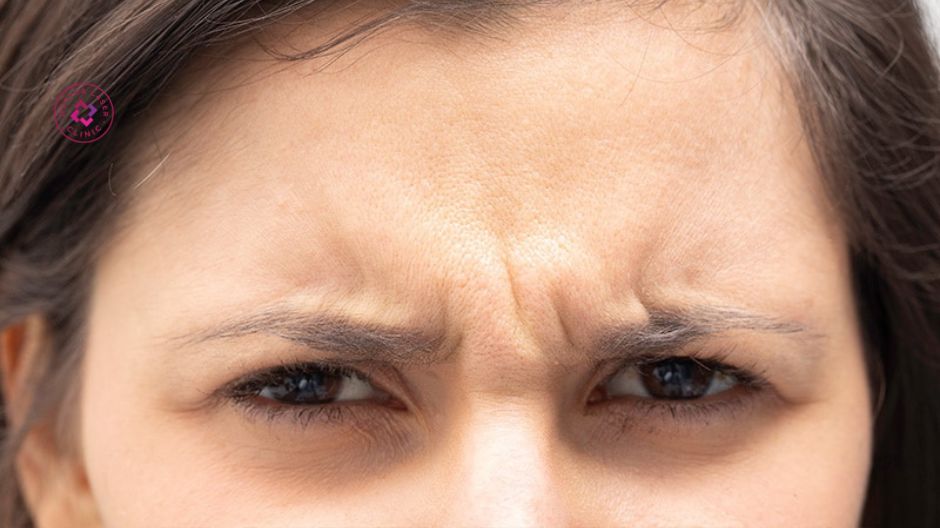 đối tượng phù hợp tiêm botox xoá nhăn cau mày