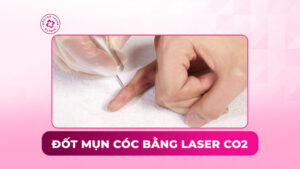 đốt mụn cóc bằng laser co2