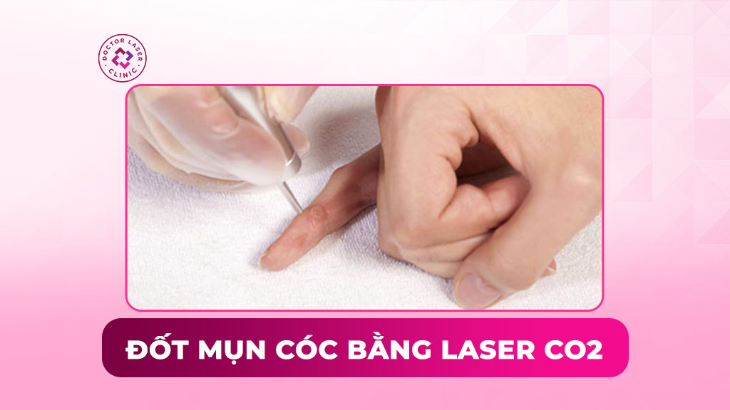 Đốt mụn cóc bằng Laser CO2 có an toàn không?