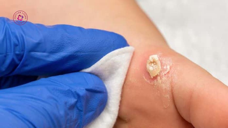 đốt mụn cóc laser co2 có an toàn không