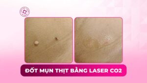 đốt mụn thịt bằng laser co2
