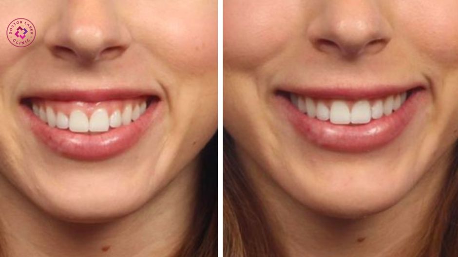 giảm hở lợi sau tiêm botox