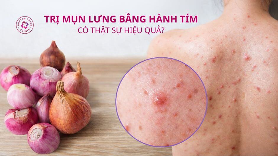 hành tím hỗ trợ trị mụn lưng