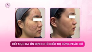 hết mụn da ổn định nhờ điều trị đúng phác đồ