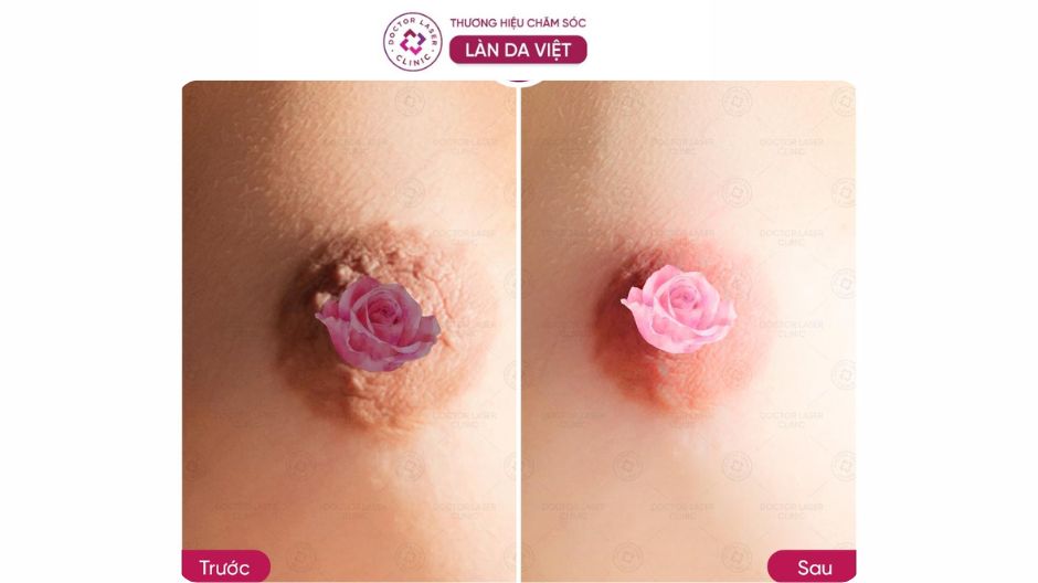 hiệu quả kem làm hồng nhũ hoa revskin revpink cream