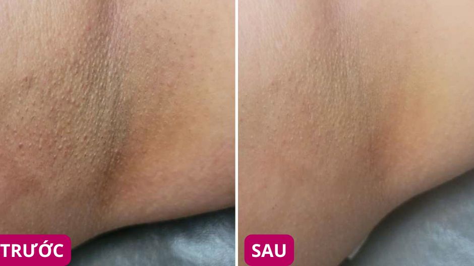 hiệu quả muối tắm tẩy tế bào chết nách dr cosmess