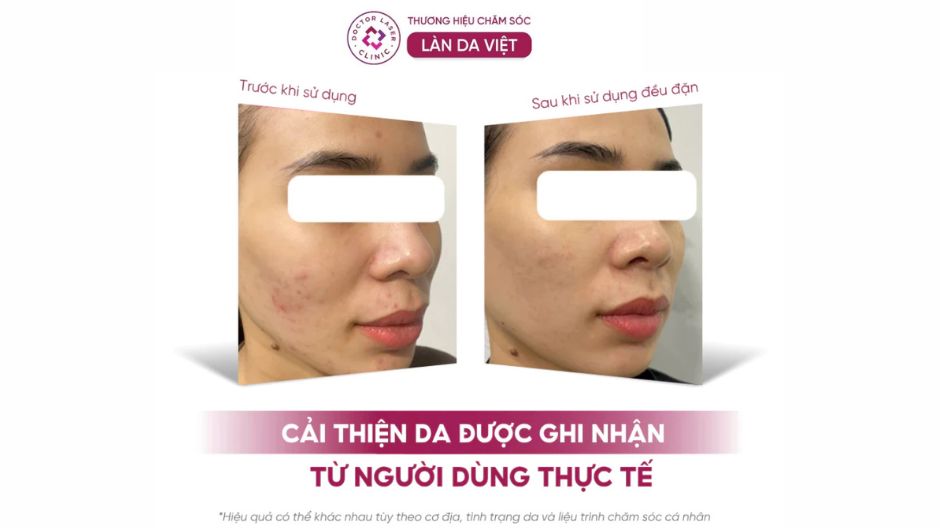 hiệu quả sữa rửa mặt revskin activecare cleanser