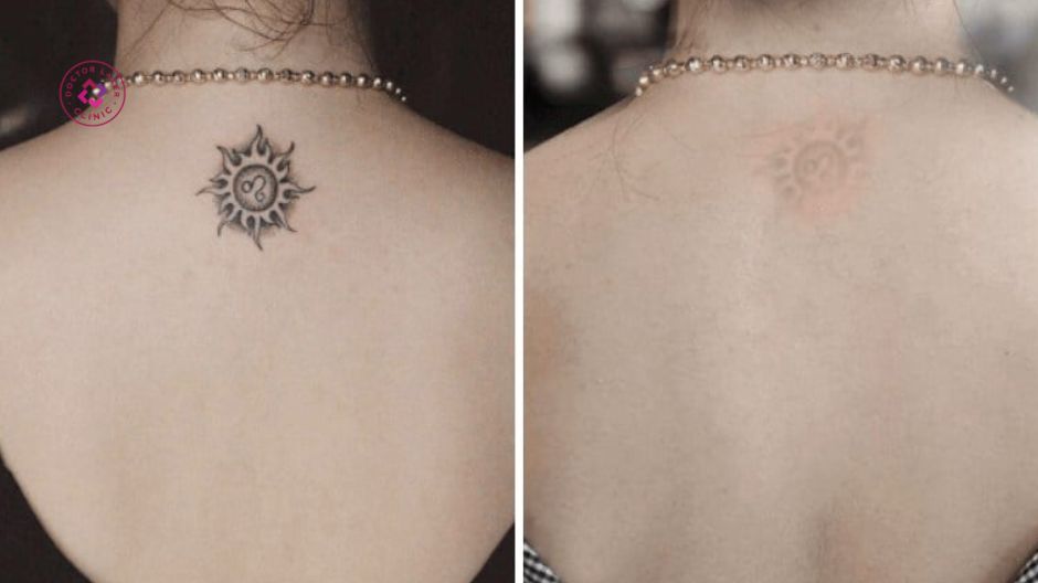 hiệu quả xóa xăm pico laser