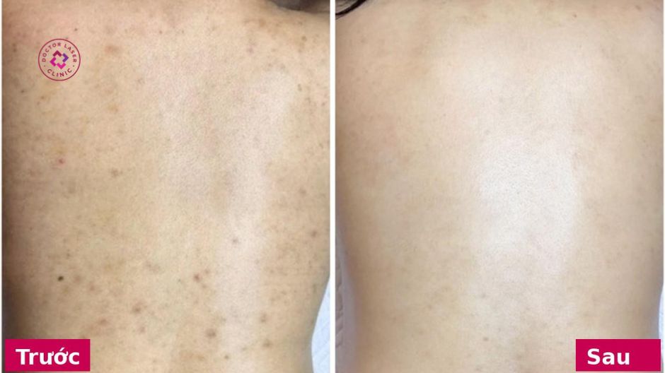 hình ảnh kết quả combo trị mụn lưng dr. clariv