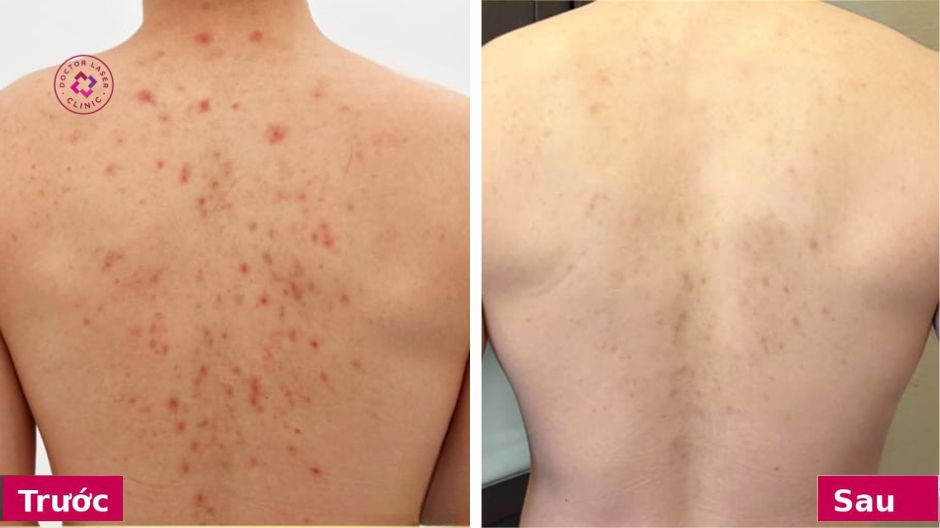 hình ảnh sử dụng combo trị mụn lưng dr clariv