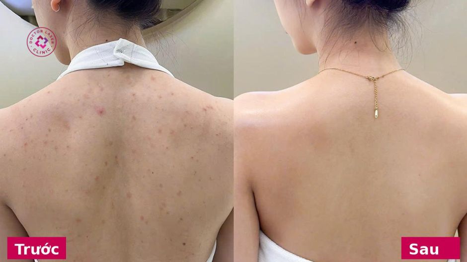 hình ảnh trước sau dùng combo trị mụn lưng dr clariv