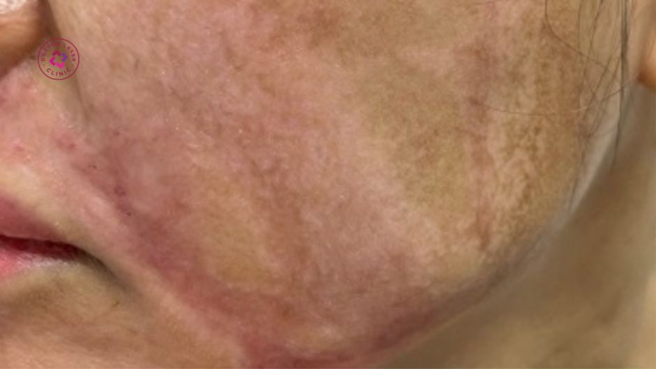 hình thành sẹo sau laser co2 fractional