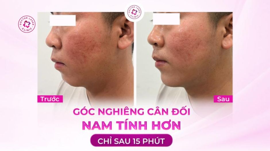 kết quả cải thiện cằm lẹm nam giới sau điều trị