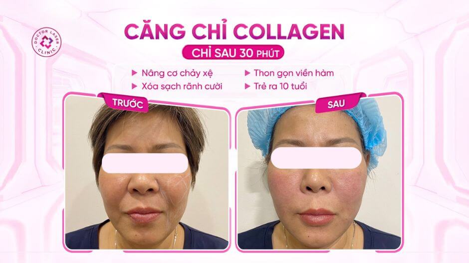kết quả cải thiện rãnh cười sau căng chỉ collagen
