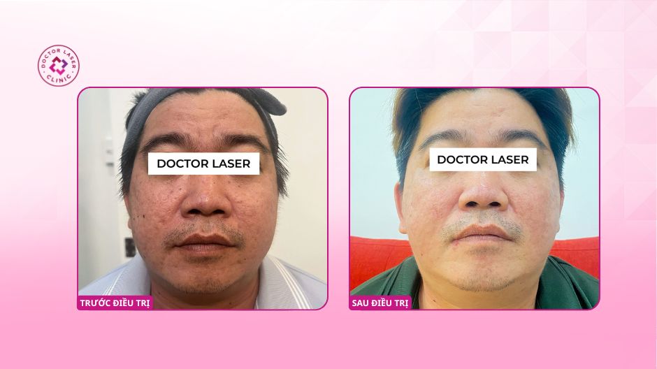 kết quả cải thiện sẹo rỗ trước sau