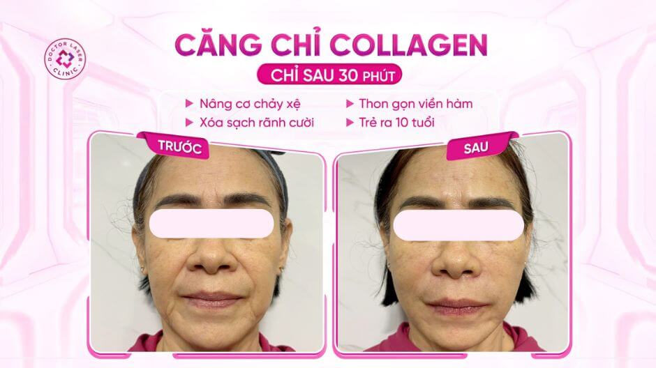 kết quả căng chỉ collagen cải thiện da mặt chảy xệ