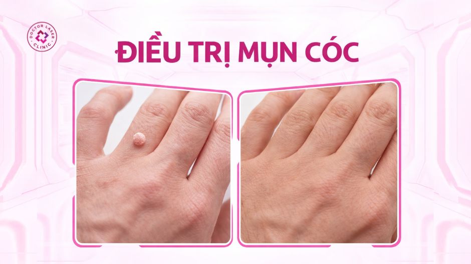 kết quả điều trị mụn cóc trước sau