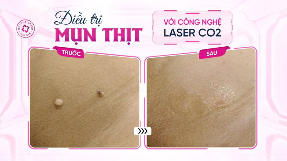 kết quả điều trị mụn thịt bằng laser co2