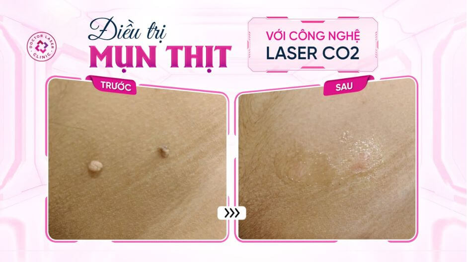 kết quả điều trị mụn thịt vùng cổ sau laser co2