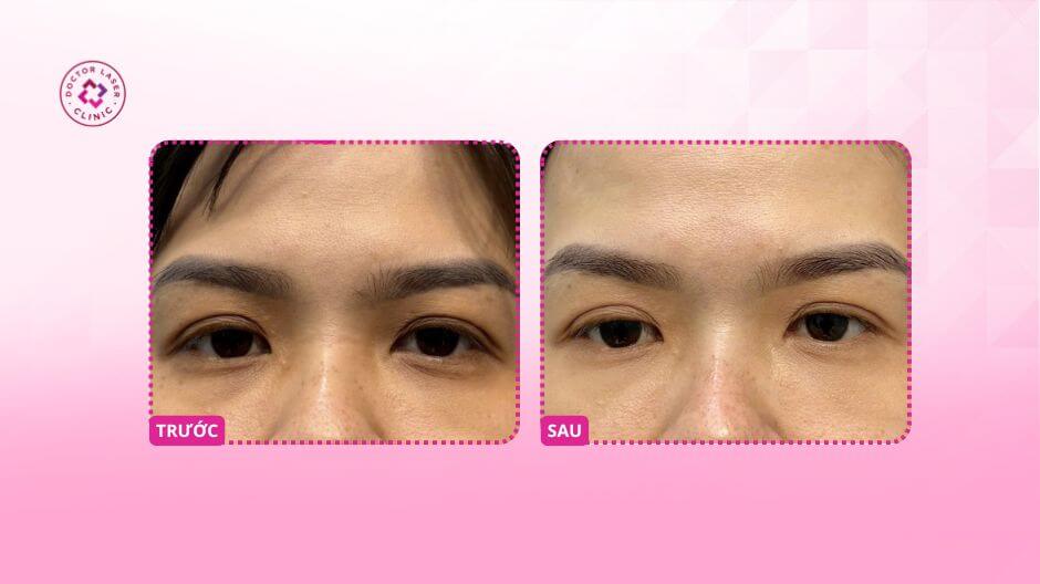 Kết quả cải thiện thâm mắt sau liệu trình Laser Pico kết hợp meso