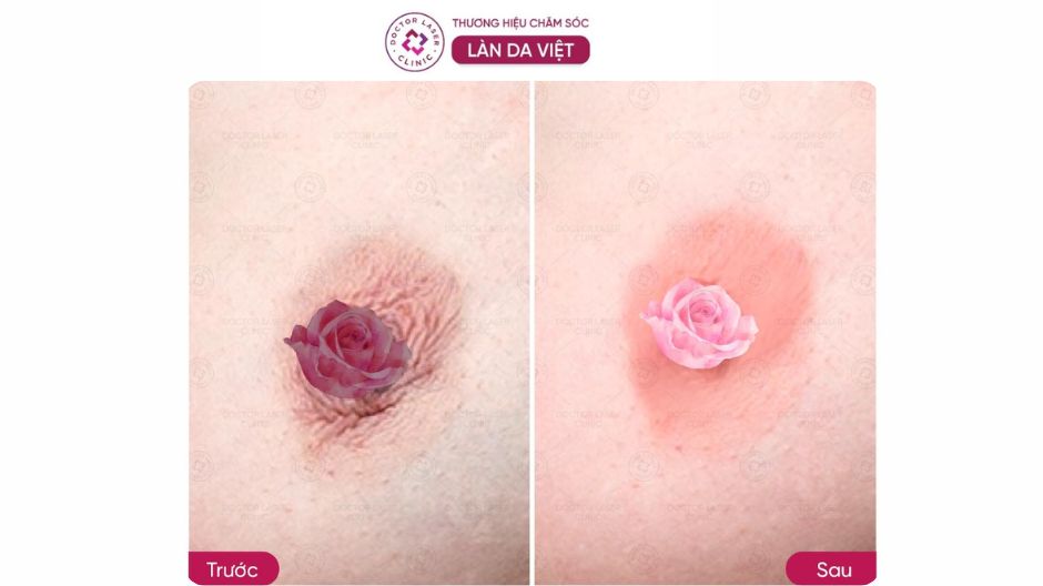 kết quả kem làm hồng nhũ hoa revskin revpink cream