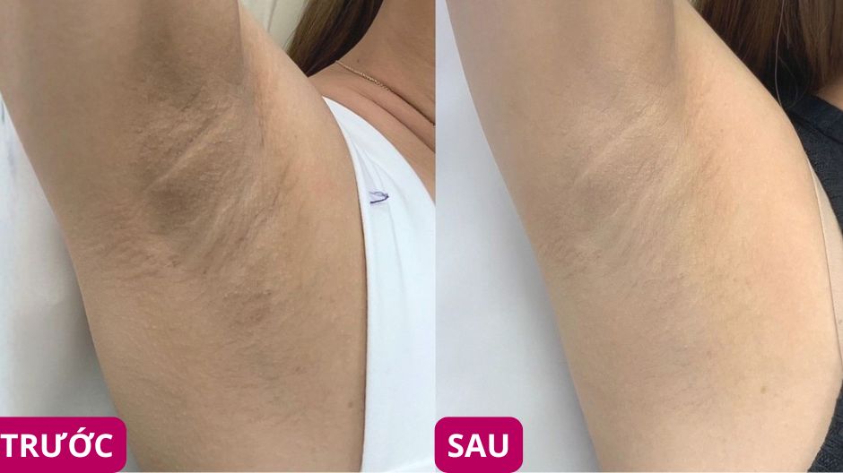 ket-qua-su-dung-muoi-tam-tay-te-bao-chet-nach-dr-cosmess