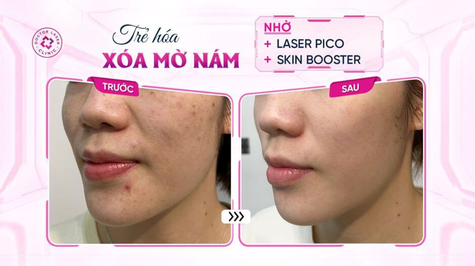 kết quả sau điều trị sắc tố da laser pico skin booster