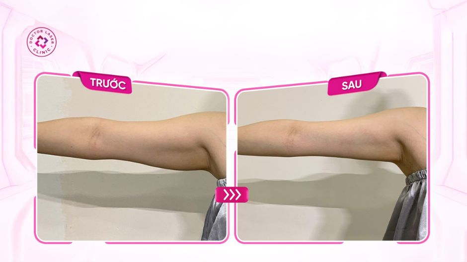 kết quả trước sau tiêm botox bắp tay