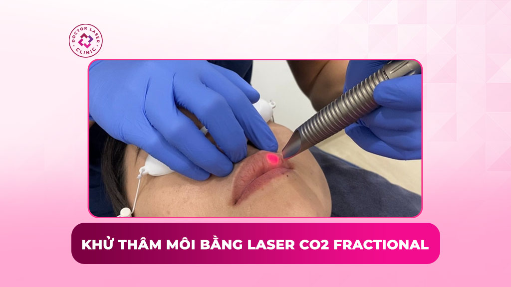 Khử thâm môi bằng Laser CO2 Fractional có tốt không?