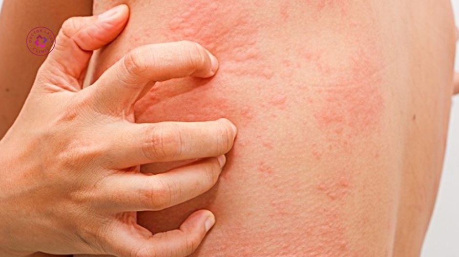 kích ứng thuốc tê lidocaine sau tiêm meso