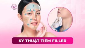 kỹ thuật tiêm filler