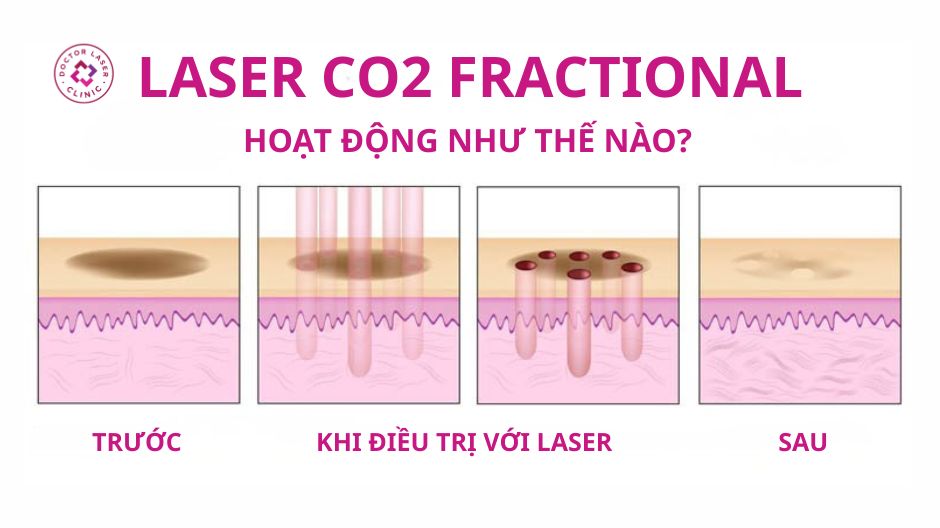 laser co2 fractional là gì