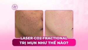 laser co2 fractional trị mụn như thế nào