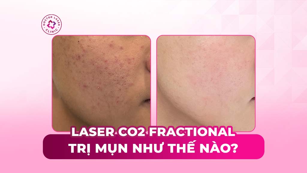 Laser CO2 Fractional trị mụn giúp ngăn ngừa sẹo sớm