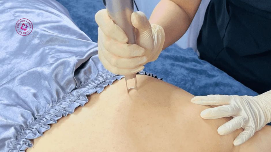 laser diode lấy nhân mụn lưng